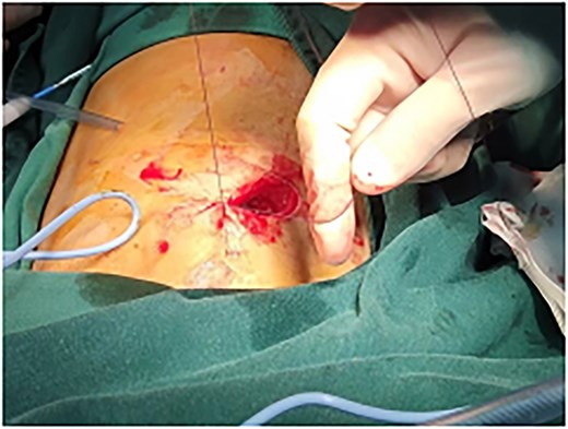 Use absorbable sutures to perform `8' deep-layered suture.