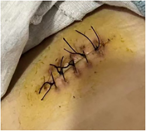 Situation after wound suturing.