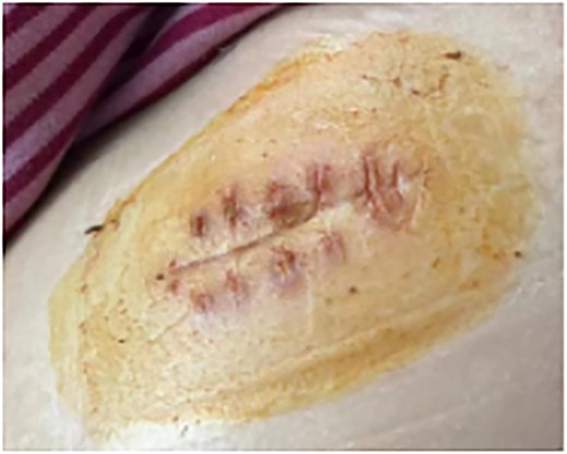 Condition after wound healing.