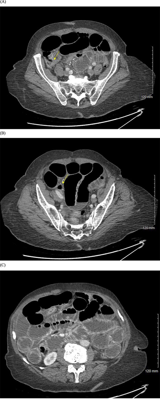 (A, B) CT abdomen and pelvis with IV contrast showing evidence of small bowel obstruction with two transition points in the right lower quadrant (yellow arrows). (C) Dilated loops of small bowel with air-fluid levels.