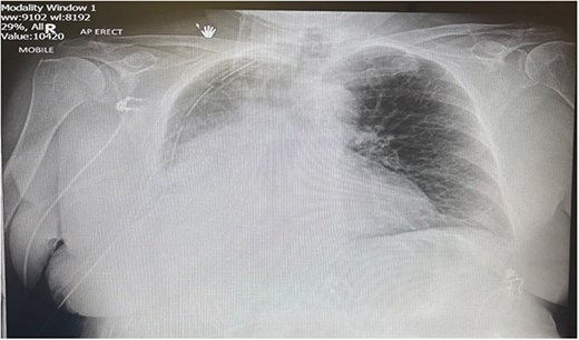 Portable chest X-ray Day 2 postoperatively. Chest X-ray depicts right middle and lower zone consolidation with associated pleural effusion.