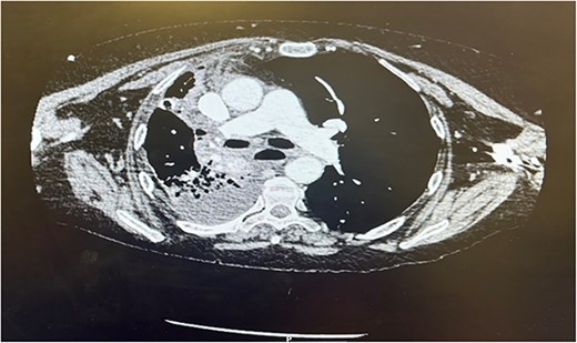 CT thorax Day 3 postoperatively. Right sided pleural effusion with overlying atelectasis and segmental collapse of the right middle and lower lobe.
