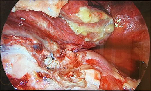 UVATS camera image depicting fibrin tissue formation of early stage empyema within the hilar and azygos region.