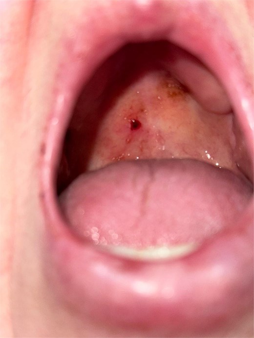 Clinical image of the oropharynx showing a sessile erythematous lesion on the right soft palate. The lesion appears as a friable, lobulated mass arising directly from the palatal mucosa without a pedicle.