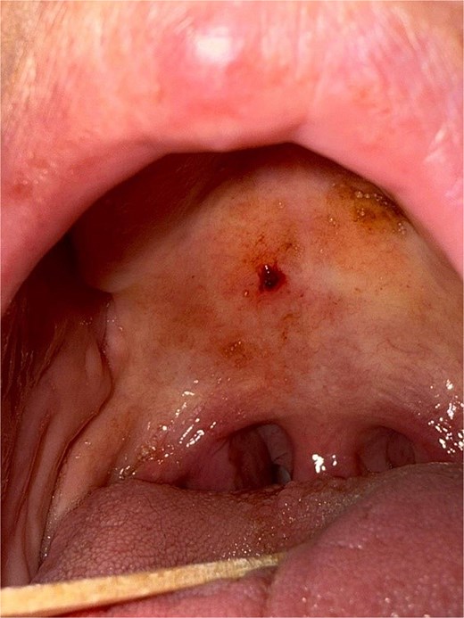 Closer view of the lesion with a tongue depressor for retraction. The lobulated, vascular surface of the PG is evident.