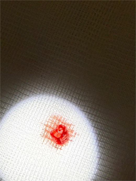 Excised specimen of the lesion placed on sterile gauze immediately after removal. The mass appears as a lobular red soft-tissue fragment.