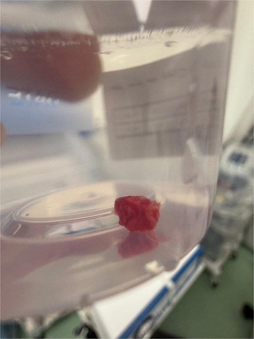 The excised lesion stored in a formalin container for pathological examination. The globular tissue specimen corresponds to the removed PG.