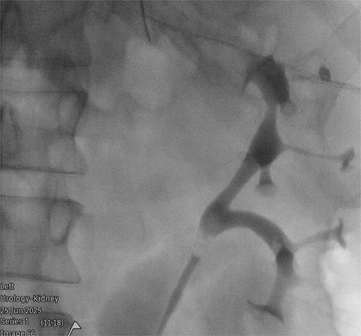 Retrograde urethrogram under fluoroscopic guidance, demonstrating a partially duplicated collecting system, with two renal pelvices converging into a single intact ureter.