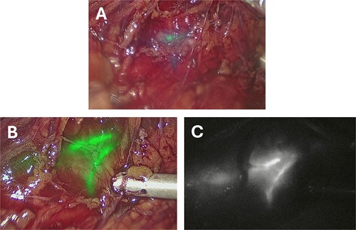 Intraoperative images taken after instillation of 12.5 mg (5 ml) ICG into a left ureteric stent taken using a Storz Opal1® 4 K-NIR/ICG laparoscopic camera. (A) Taken approximately 30 seconds after ICG administration. (B) Taken approximately 5 minutes after administration using the overlay visualization mode. (C) Taken approximately 5 minutes after administration using the monochromatic visualization mode.