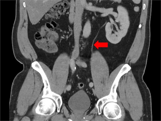 CT scan taken 1 year pre-operatively during a prior episode of acute sigmoid diverticulitis, showing a single ureter (arrow) descending from the left kidney, which entered the bladder at a single ureteric orifice.