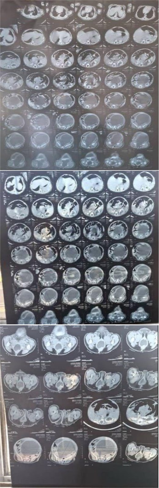 CT demonstrates a markedly distended, fluid-filled vaginal cavity in this infant, consistent with hydrocolpos, extending superiorly and exerting mass effect on adjacent pelvic organs, with secondary bilateral hydronephrosis.