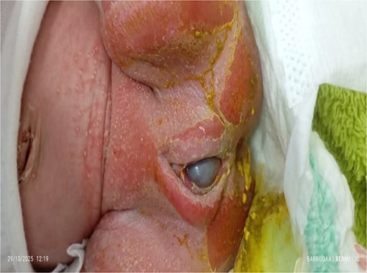 Diaper dermatitis with a visible vaginal bulge.