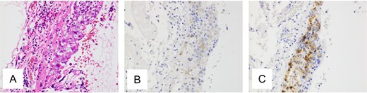 Pathological findings of ovarian tumor for Case 1. (A) Hematoxylin and eosin staining, ×400 show tumor growing in the ovarian cyst. Most of the tumor consists of a mature cystic teratoma, but a focal area demonstrates atypical cell proliferation with surrounding lymphocytic infiltration. (B, C) Immunohistochemical staining, ×400 is positive for c-kit protein and placental alkaline phosphatase.