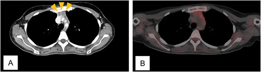 Computed tomogram and fluorodeoxyglucose positron emission tomogram/computed tomogram of Case 1. (A) Chest contrast-enhanced computed tomogram shows a 2 x 1 cm anterior mediastinal mass with increased fat attenuation (arrowhead). (B) No abnormal uptake is seen in the thymic mass on fluorodeoxyglucose positron emission tomogram/computed tomogram.