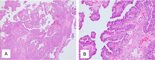 Pathological findings of ovarian tumor for Case 2. (A) Hematoxylin and eosin staining, ×40 and (B) hematoxylin and eosin staining, ×400 show peritoneal dissemination of the ovarian tumor. Morphologically, the tumor shows large papillary structures characteristic of adenocarcinoma, representing a typical appearance of high-grade serous carcinoma.