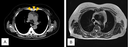 Computed tomogram and magnetic resonance image of Case 2. (A) Chest computed tomogram shows a 4 x 3 cm anterior mediastinal mass with increased fat attenuation (arrowhead). (B) T2-weighted magnetic resonance image of the chest shows heterogeneous fatty signal within the thymus, but no solid component is observed.