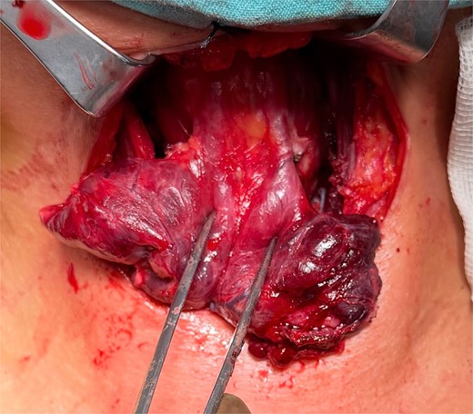 Intraoperative view demonstrating two PLs arising from the superior aspect of the thyroid isthmus and extending cranially toward the infrahyoid region.