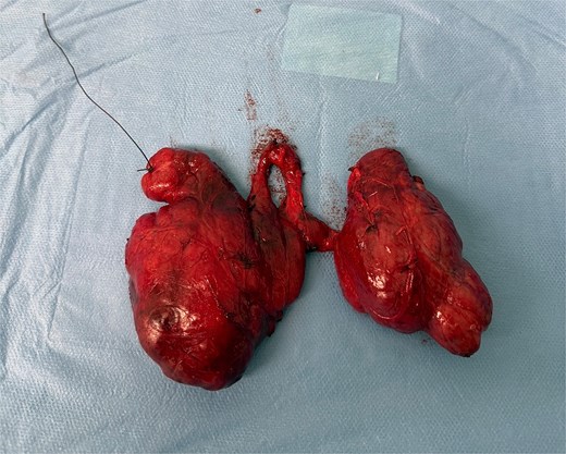 Macroscopic view of the excised thyroid specimen showing two distinct PLs connected to the isthmus by narrow stalks.
