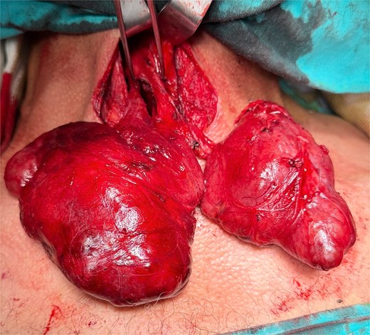 Preoperative view of double PL.