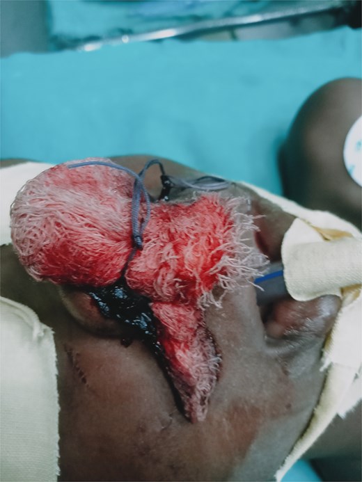 Blood-soaked gauze secured to the columella with blood clots around the nares.