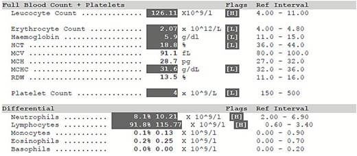 Full blood picture: Severe anemia, massive leucocytosis with lymphocyte predominance and severe thrombocytopenia.
