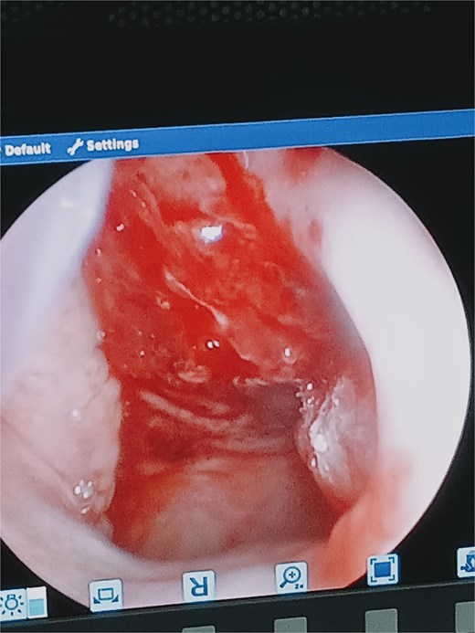 Nasoendoscopy through the left nostril showing mucosal injury on the roof and posterior wall of the nasopharynx, with active bleeding.