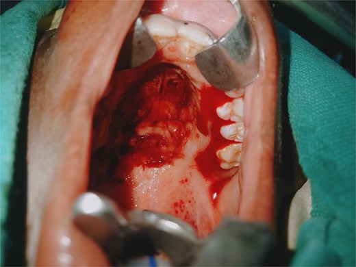 Oral cavity examination showing actively bleeding lacerations on the soft palate and left tonsillar pillar.