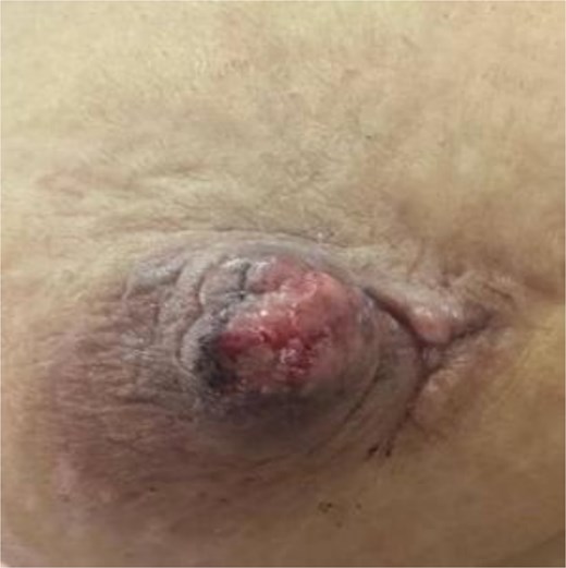 Picture of the nipple neuroma before surgery.