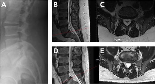 Radiological regression of lumbar spinal epidural lipomatosis (L5/S1) between October 2024 and September 2025. (A) Lateral lumbar spine radiograph (October 2024) showing preserved vertebral alignment without instability but indirect signs of reduced dorsal epidural space at L5/S1. (B, C) Baseline MRI (October 2024). Sagittal and corresponding axial T2-weighted sequence at L5/S1 level demonstrates marked epidural fat accumulation at L5/S1 with compression of the thecal sac. (D, E) Follow-up MRI (September 2025) after massive GLP-1–induced weight loss. Sagittal and corresponding axial T2-weighted image at L5/S1 level shows substantial reduction of epidural fat with re-expansion of the thecal sac.
