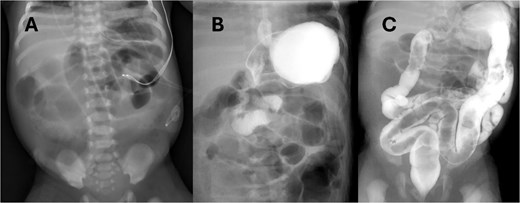 (A) AXR on DOL1 showing diffuse small bowel dilation, status post placement of replogle. (B) UGI revealing passage of contrast without evidence of malrotation or volvulus. (C) CE with normal caliber colon and no filling defect.