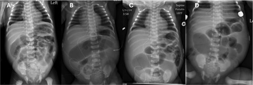 Progression of AXR. Note the changing bowel gas patterns. (A) DOL 2. (B) DOL 5. (C) DOL 6. (D) DOL 10 with concern for pneumatosis.