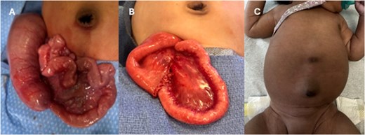 (A) Operative findings of ileal stenosis. (B) Postoperative resection with anastomosis. (C) Clinical follow-up with well healed right lower quadrant scar.