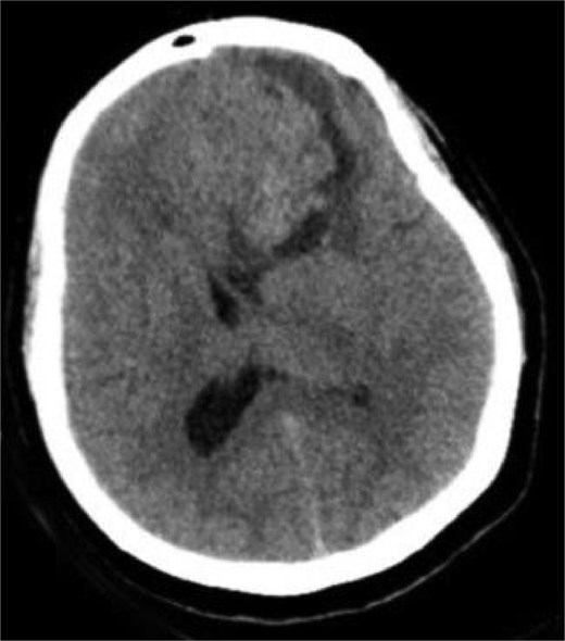 Preoperative CT brain without contrast (axial view) showing a well-circumscribed mass in the right frontal lobe resting on the falx cerebri, causing leftward midline shift with associated vasogenic edema and mass effect.