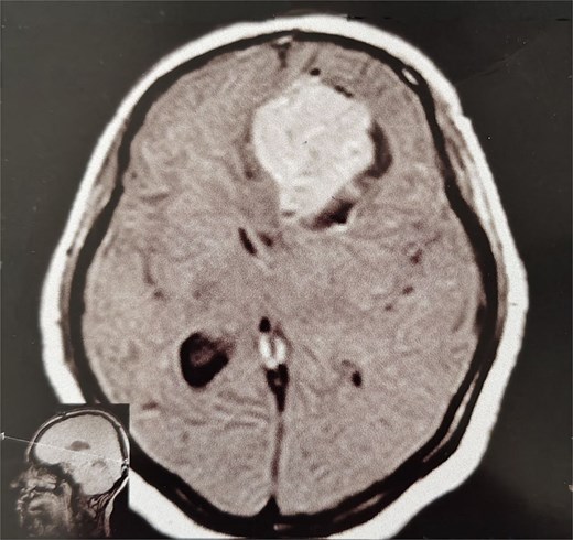 MRI brain without IV contrast (T1 sequence) showing a well-circumscribed hypointense mass with areas of heterogeneity occupying the right frontal lobe, closely related to the midline structures and falx cerebri.