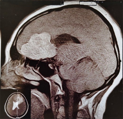 MRI brain with IV contrast (sagittal midline view) showing a homogeneously enhancing mass based on the cribriform plate of the ethmoid, displacing the frontal lobe upward and posteriorly.