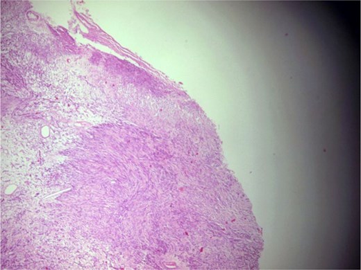 Photomicrograph showing a well-circumscribed, partially encapsulated lesion composed of hypercellular Antoni a areas admixed with myxoid hypocellular Antoni B areas (H&E, ×100).
