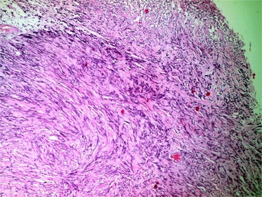 Photomicrograph of hypercellular Antoni a areas showing interlacing bundles of spindle-shaped cells with nuclear palisading (H&E, ×400).