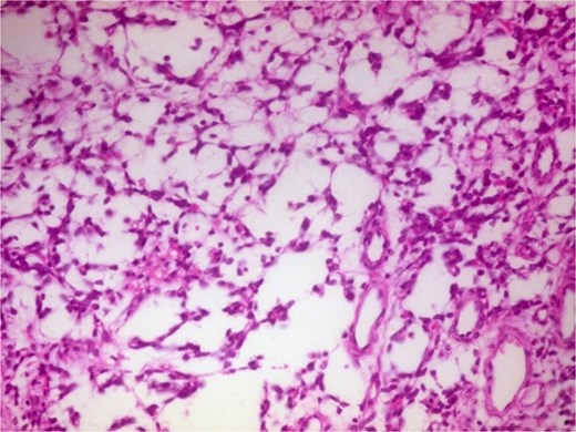 Photomicrograph of hypocellular Antoni B areas showing few cuboidal cells separated by myxoid stroma (H&E, ×400).