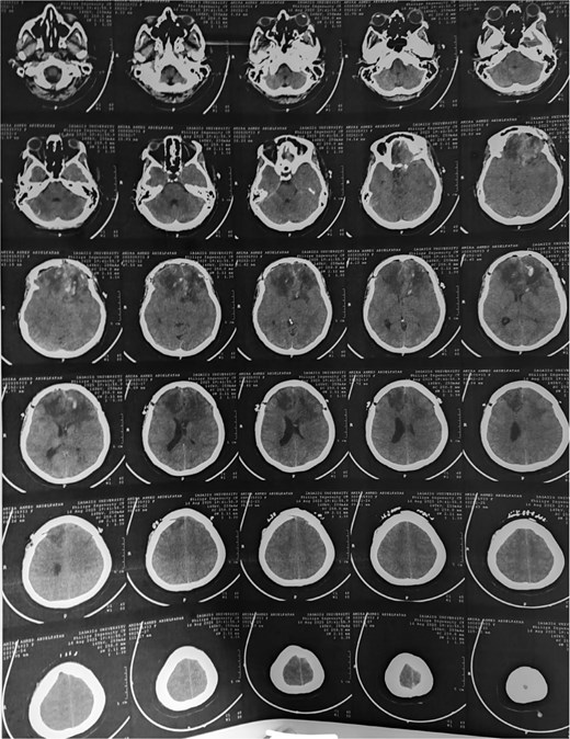 Post-op CT brain showing total excision of the tumor leaving mild post-op oedema at tumor bed.