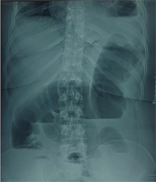 Image of an unprepared abdomen in a standing position, centered on the diaphragmatic domes, showing colonic and small bowel distension with air-fluid levels.