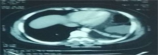 Axial section of an abdominal-pelvic CT scan showing a strangulated Bochdalek hernia with colonic and omental contents.