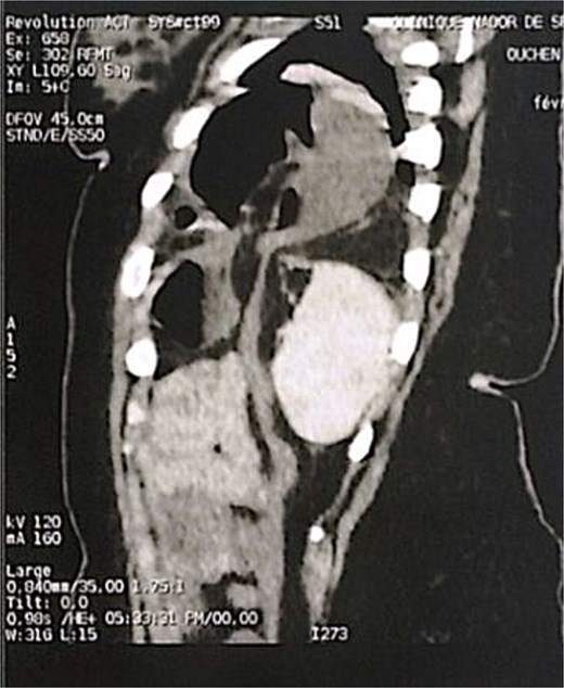 Sagittal section of an abdominal-pelvic angiogram showing a strangulated Bochdalek hernia with colonic and omental contents.