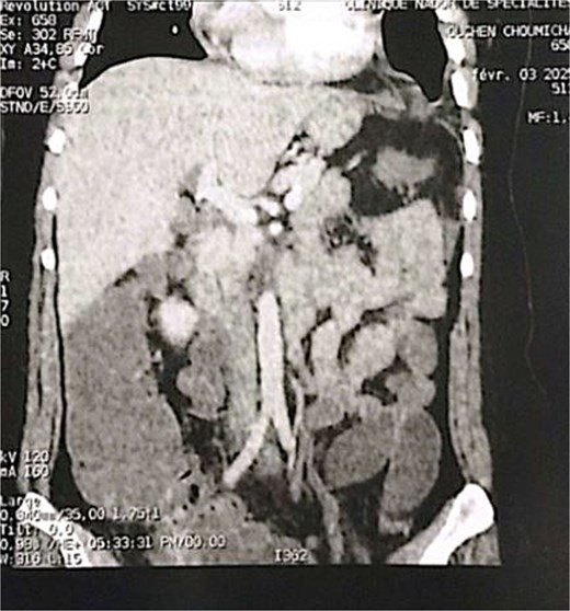 Coronal section of an abdominal-pelvic angiogram showing a strangulated Bochdalek hernia with colonic and omental contents.