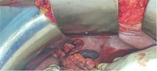 Intraoperative image showing a left Bochdalek hernia.