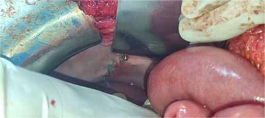 Intraoperative image after suturing of Bochdalek hernia.