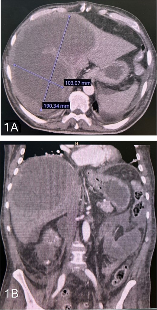 (A) axial contrast-enhanced CT scan showing a large hepatic abscess involving segments IVa, V, VII, and VIII. (B) Coronal contrast-enhanced CT showing free fluid around the bowel and in the peritoneal cavity.