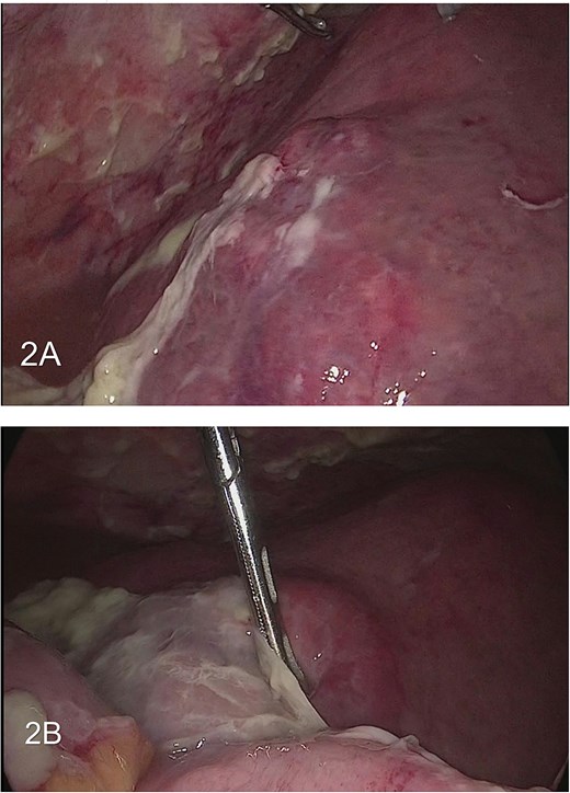 (A) large hepatic abscess with large purulent collection. (B) Purulent collection within the bowel.