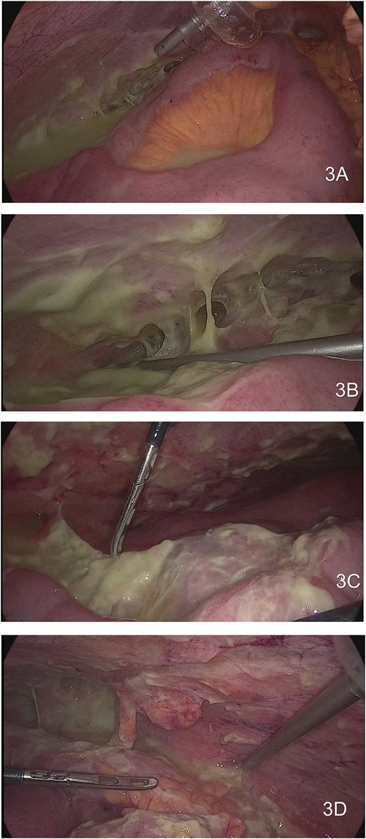 Showing large purulent content that involve the majority of the abdominal cavity. (3A) Right parietocolic gutter and abscess between the intestines. (3B) Right hypochondrium with purulent adhesions. (3C) Multiple fibro adhesion bands in the small bowel. (3D) Purulent content involving in the pelvic cavity.