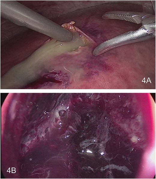 Drainage of large hepatic abscess. (A) Drainage of multiple collection in the liver. (B) View inside the large hepatic abscess.