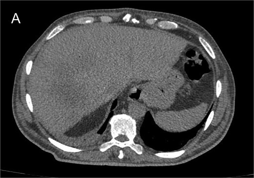 Non-contrast abdominal CT scan at 1-month postoperatively showing significant reduction in intrahepatic collection.